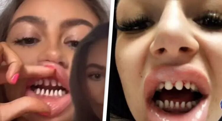 Internete plinta nauja nušlifuotų dantų mada. Stomatologai perspėja, kas laukia šios mados aukų po 10 metų
