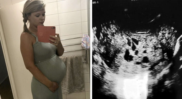 27-erių moteris be galo džiaugėsi nėštumu, tačiau viskas pasikeitė, kai tyrimo metu gydytojai pamatė sukrečiantį vaizdą