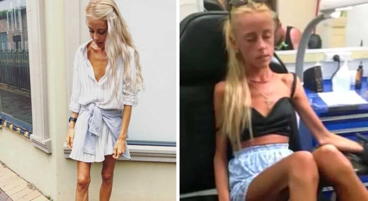 Prieš 8 metus gydytojai merginai atvirai sakė, kad dėl anoreksijos jai liko gyventi vos keli mėnesiai. Tačiau visi sunkiai patiki tuo, kaip ji atrodo šiandien