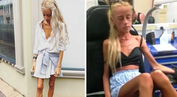 Prieš 8 metus gydytojai merginai atvirai sakė, kad dėl anoreksijos jai liko gyventi vos keli mėnesiai. Tačiau visi sunkiai patiki tuo, kaip ji atrodo šiandien